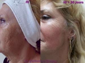 Les effets du peeling mosaïque TCA/Phénol
