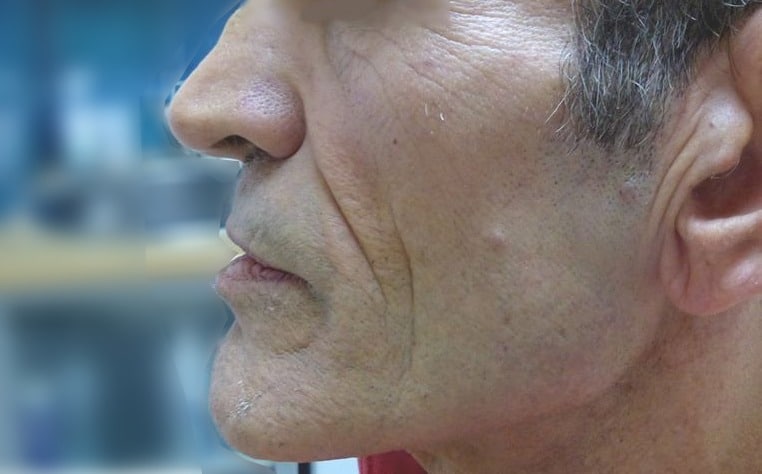 forts sillons nasogéniens sur un visage creux