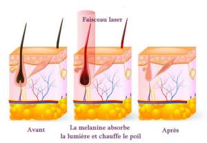 Principe de l'épilation laser
