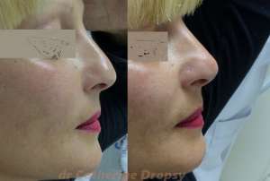 Rhinoplastie médicale avec injection d'acide hyaluronique