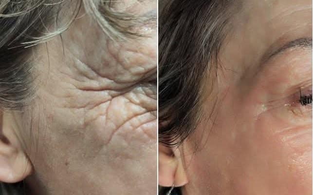 Blépharoplastie chimique au phénol : rides de la patte d oie avant et après traitement