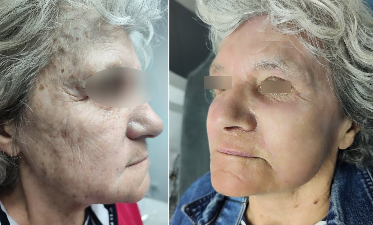 Peeling Exopeel : visage avant et après, rajeunissement global de la peau