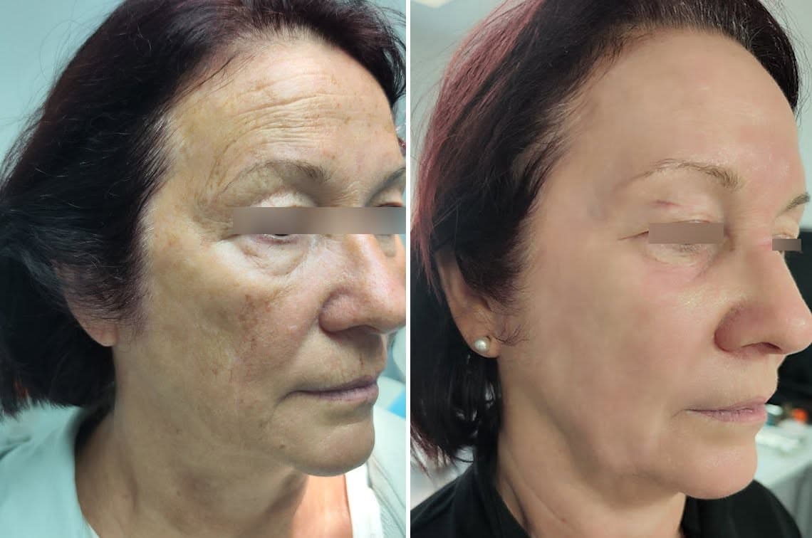 Peeling Exopeel : taches pigmentaires du visage avant et après traitement