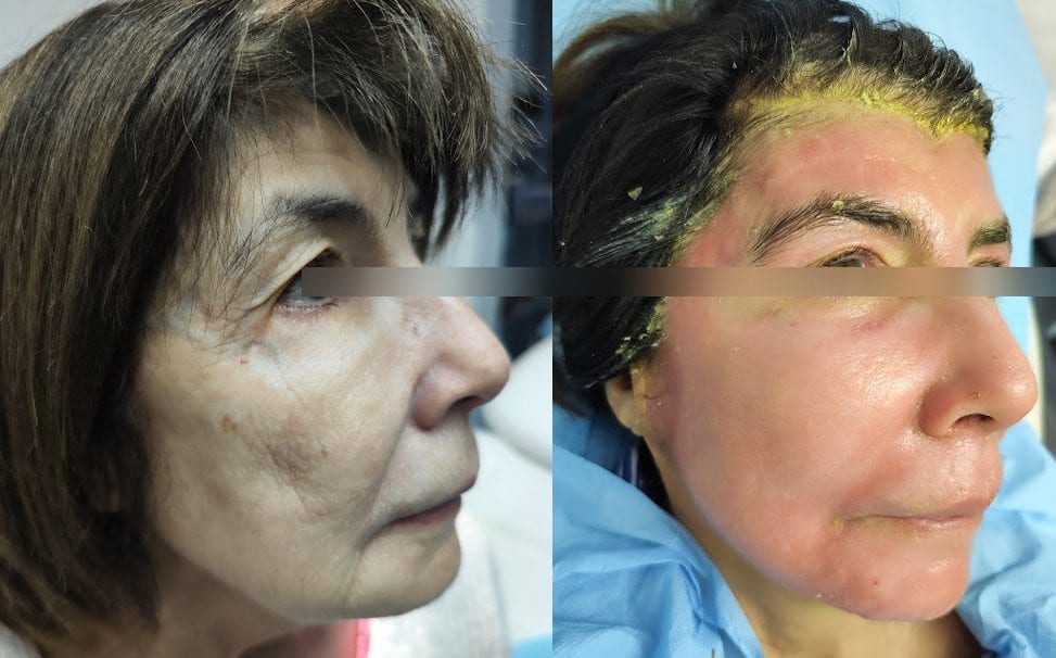 Peeling Exopeel : peau avant traitement et pendant la phase de desquamation contrôlée
